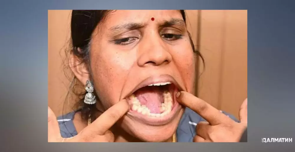Жительницу Индии признали женщиной с самым большим количеством зубов в мире